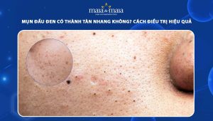 mụn đầu đen có thành tàn nhang