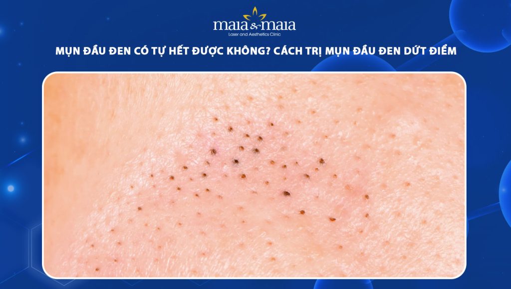 Mụn đầu đen có tự hết được không? Cách điều trị dứt điểm 1 mụn đầu đen có tự hết được không