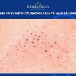 mụn đầu đen có tự hết được không