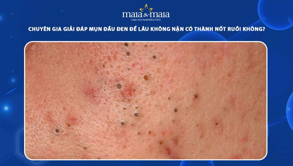 Chuyên gia giải đáp mụn đầu đen để lâu không nặn có thành nốt ruồi không? 1 mụn đầu đen để lâu không nặn có thành nốt ruồi