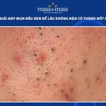 mụn đầu đen để lâu không nặn có thành nốt ruồi