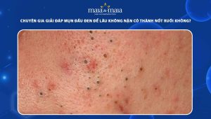 mụn đầu đen để lâu không nặn có thành nốt ruồi