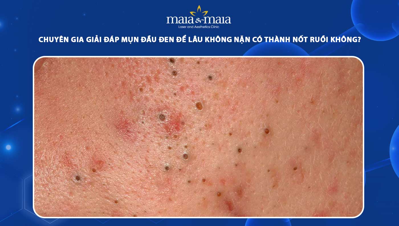 mụn đầu đen để lâu không nặn có thành nốt ruồi