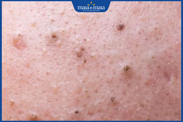 Mụn đầu đen có thành tàn nhang không? Cách điều trị hiệu quả 2 mụn đầu đen lan rộng