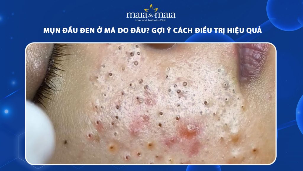 mụn đầu đen ở má