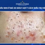 mụn đầu đen ở má