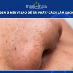 mụn đầu đen ở mũi