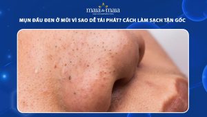 mụn đầu đen ở mũi