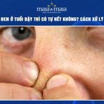 mụn đầu đen ở tuổi dậy thì