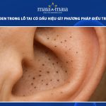 mụn đầu đen trong lỗ tai