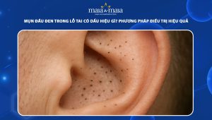 mụn đầu đen trong lỗ tai