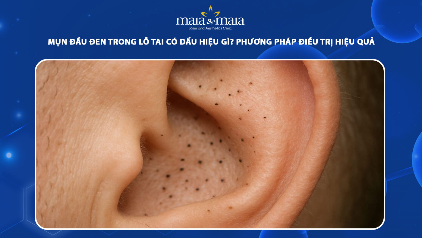mụn đầu đen trong lỗ tai