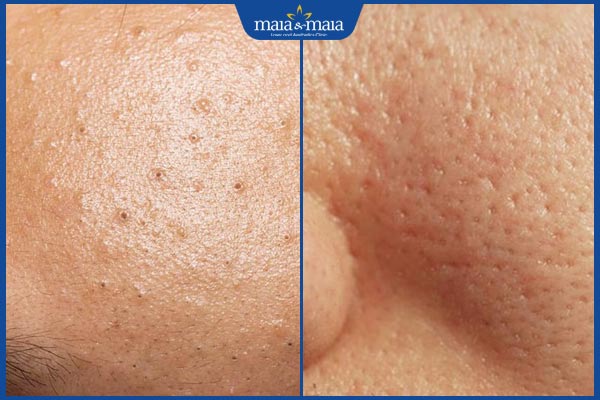 mụn đầu đen và lỗ chân lông to