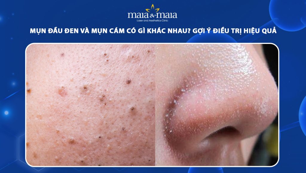 mụn đầu đen và mụn cám