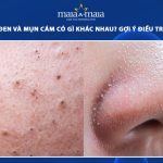 mụn đầu đen và mụn cám