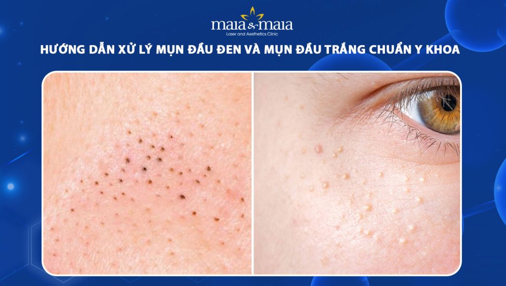 Hướng dẫn xử lý mụn đầu đen và mụn đầu trắng chuẩn y khoa 1 mụn đầu đen và mụn đầu trắng