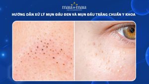mụn đầu đen và mụn đầu trắng