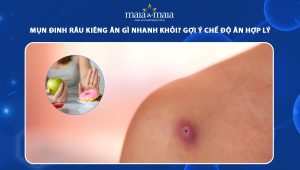 mụn đinh râu kiêng ăn gì