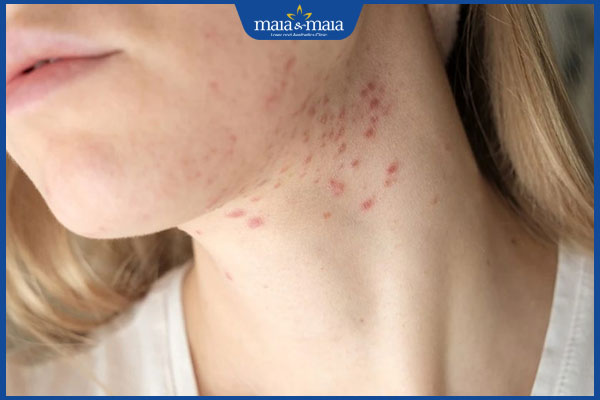 mụn đỏ lan rộng