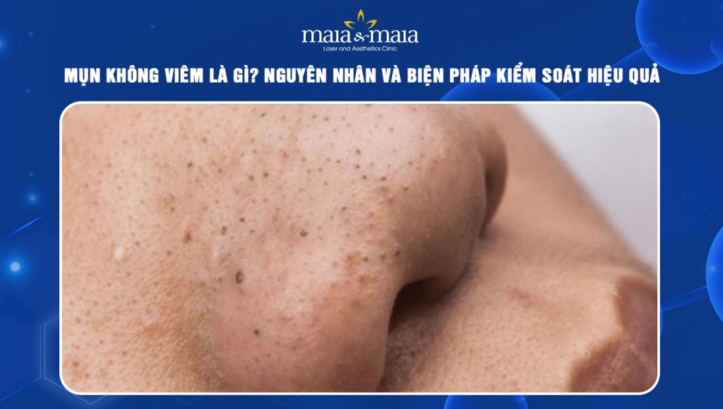 Mụn không viêm là gì? Nguyên nhân và biện pháp kiểm soát 1 mụn không viêm