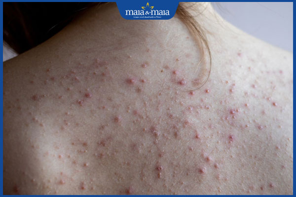 mụn lưng bị viêm