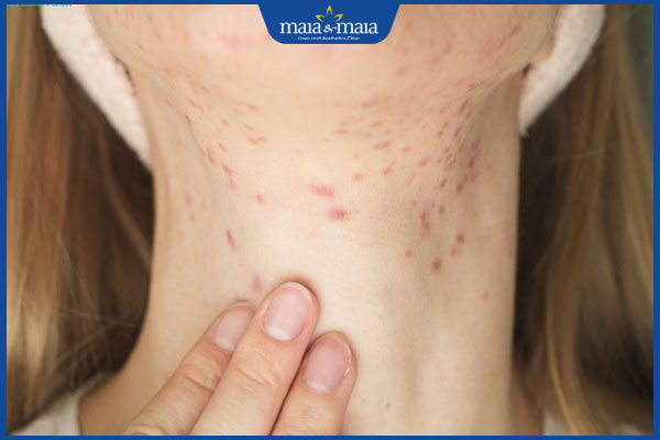 mụn mọc ở cổ