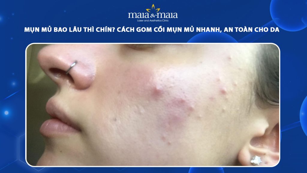mụn mủ bao lâu thì chín