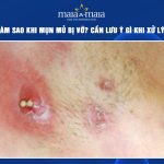 mụn mủ bị vỡ