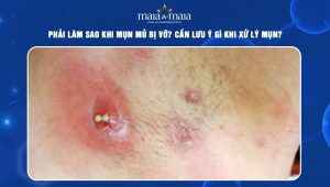 mụn mủ bị vỡ