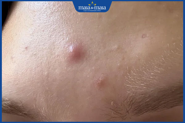 mụn mủ đang sưng tấy