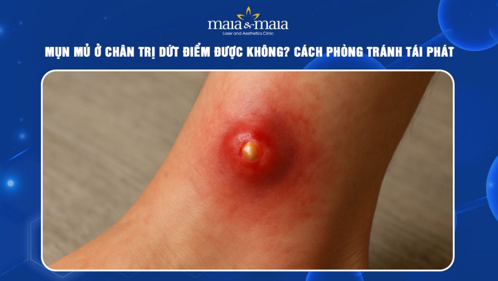 Mụn mủ ở chân điều trị thế nào? Cách phòng tránh tái phát 1 mụn mủ ở chân