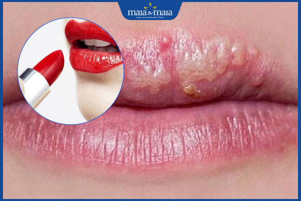 mụn nước do dị ứng mỹ phẩm