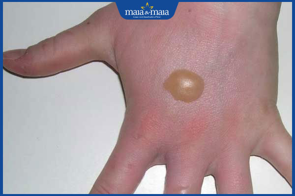 Bị kiến lửa cắn nổi mụn nước có nguy hiểm không? Cách xử lý 2 mụn nước do kiến đốt