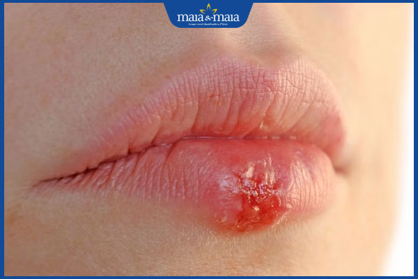 mụn nước môi nguy hiểm