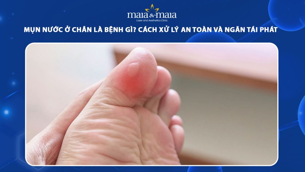 Mụn nước ở chân là bệnh gì? Cách xử lý an toàn và ngăn tái phát 1 mụn nước ở chân