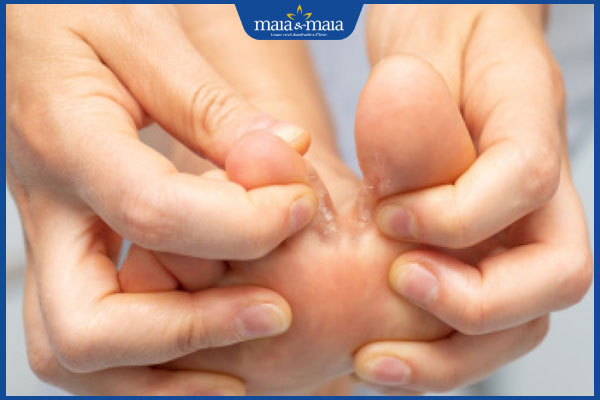 Mụn nước ở chân là bệnh gì? Cách xử lý an toàn và ngăn tái phát 2 mụn nước ở kẽ ngón chân