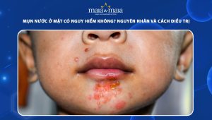 mụn nước ở mặt