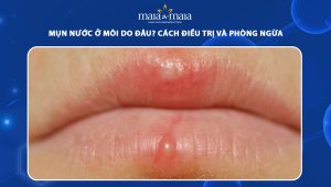 mụn nước ở môi