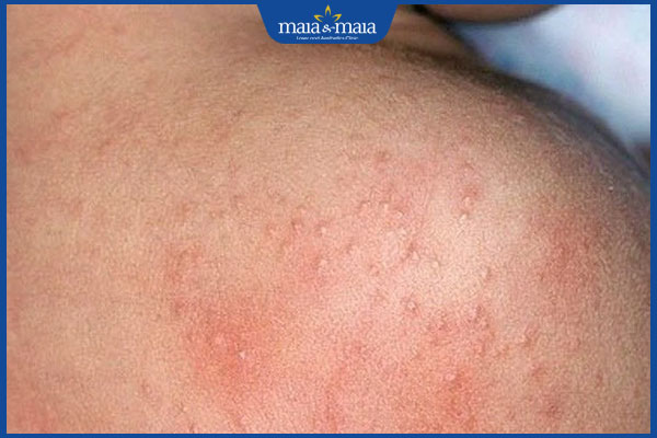 mụn nước rôm sảy