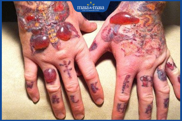 Hình xăm bị nổi mụn nước có sao không? Cách khắc phục an toàn 3 mụn nước to