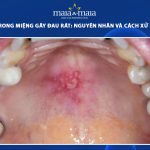 mụn nước trong miệng