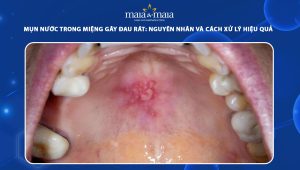 mụn nước trong miệng