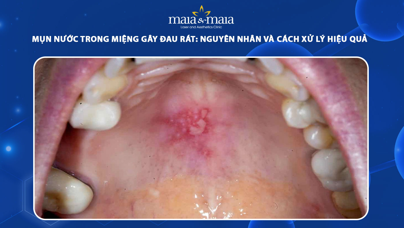 mụn nước trong miệng