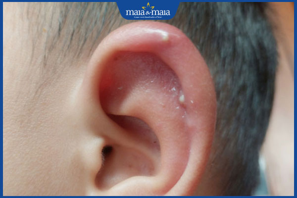 mụn ở tai