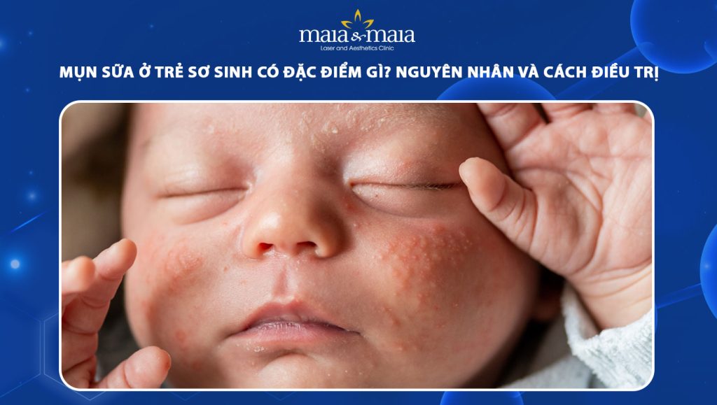 mụn sữa ở trẻ sơ sinh