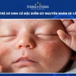 mụn sữa ở trẻ sơ sinh