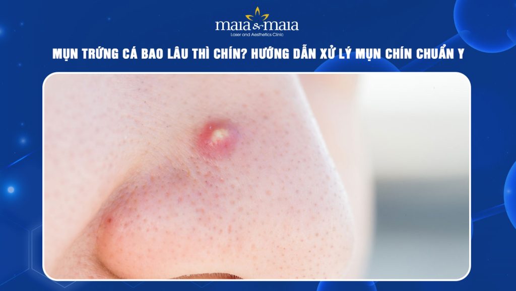 Mụn trứng cá bao lâu thì chín? Cách xử lý mụn chín chuẩn y khoa 1 mụn trứng cá bao lâu thì chín