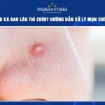 mụn trứng cá bao lâu thì chín