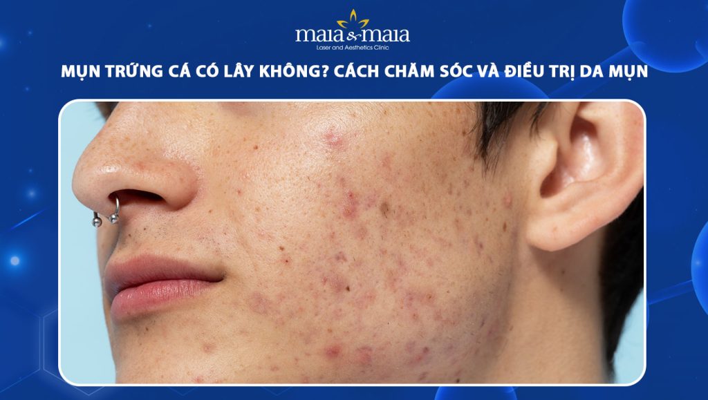 mụn trứng cá có lây không