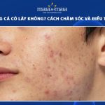 mụn trứng cá có lây không